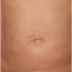 Thermage Before & After Patient #1589